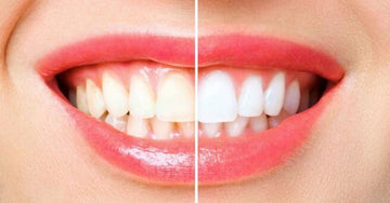 Benefícios do Clareamento Dental