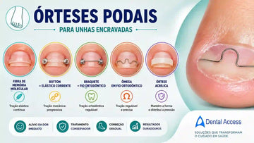 Guia Completo das Órteses Podais para Unhas Encravadas