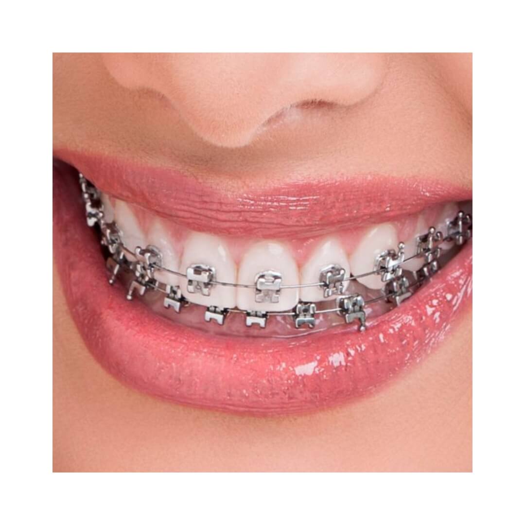 Bráquete Metal Orthoclip SLB Ultra-P Roth 0.022"U - Orthometric